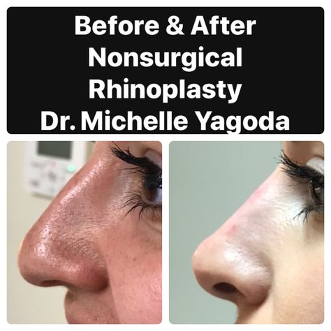 Liquid Nose Job Before And After, Ideal Nose Rhinoplasty, Liquid Rhinoplasty Before And After, Nose Inspiration, Liquid Nose Job, Liquid Rhinoplasty, Nose Lift, Nose Plastic Surgery, Nonsurgical Nose Job