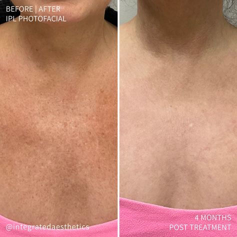 Wondering if IPL is worth it? Just look at these incredible results—we're convinced it is!

#ipl #iplphotofacial #intensepulsedlight #intensepulselight #ipltreatment #photofacial #photofacials #sundamage #sundamagedskin #sundamagetreatment #brownspots #rosacea #brokencapillaries #skinhealth #integratedaesthetics #drmelissachiang #drchiang #medspamagic Ipl Photofacial, Intense Pulsed Light, Sun Damaged Skin, Skin Resurfacing, Medical Spa, Brown Spots, Med Spa, The Hype, Skin Conditions