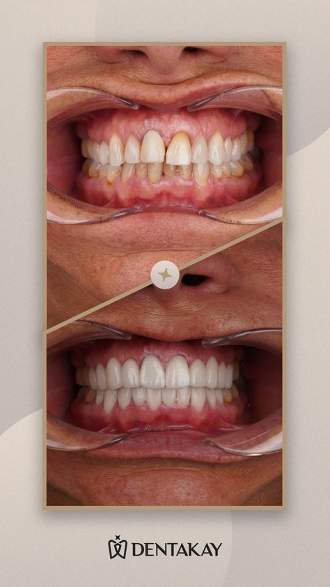 Emax crown and dental Implant Types Of Crowns, Emax Crowns, Perfect Smile Teeth, Dental Implant Procedure, Medical Words, Veneers Teeth, Dental Implants Cost, Gap Teeth, Dental Art