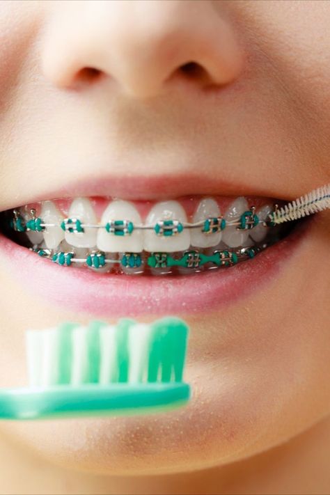 Brackets Aesthetic, Braces Colors Combinations, Braces Colors Ideas, Tooth Structure, Loose Teeth, Cute Braces Colors, Braces Cost, Adult Braces, Braces Tips