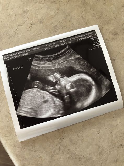 Baby Boy Ultrasound Pictures, Usg Pregnancy Photography, Boy Ultrasound Pictures, Boy Ultrasound, Baby Ultrasound Pictures, Ultrasound Sonography, Fake Pregnancy, Pregnancy Ultrasound, Ultrasound Technician