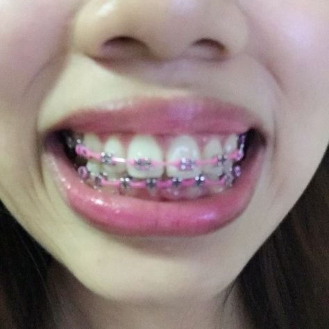 Orange Braces, Braces Colours, Power Chain Braces, Braces Ideas, Pink Braces, Red Braces, Cute Braces Colors, Pretty Teeth, Braces Tips