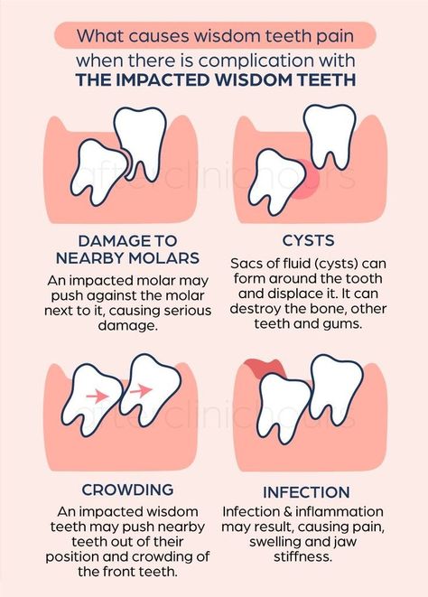 Impacted Wisdom Teeth, Wisdom Teeth Pain, Dental Assistant Study, Dental Extraction, Dental Images, Oral Maxillofacial, Dental Posters, Wisdom Tooth, Wisdom Tooth Extraction