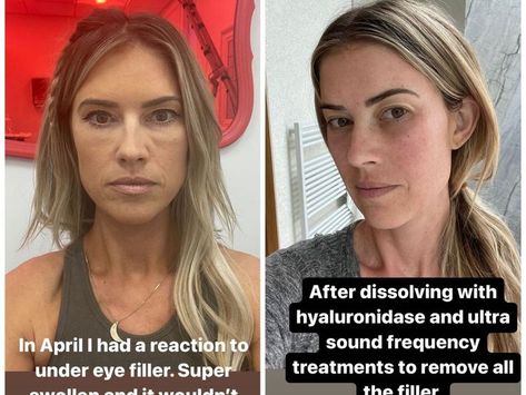 Christina Hall Says She Removed Her Under-Eye Filler After 'Inflammatory Reaction': 'Never Again' Under Eye Filler, Eye Filler, Christina Hall, Under Eye Fillers, Sound Frequencies, Never Again, Ultrasound