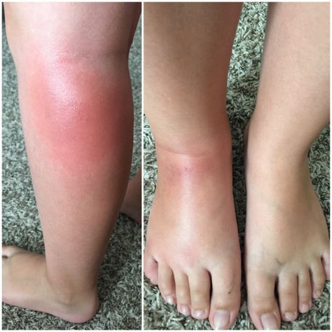 What a nightmare! Read how one family dealt with their little girl's reaction to mosquitoes. Bug Bite Remedies, Skeeter Syndrome, Bug Bite Swelling, Mosquito Bite Allergy, Allergic To Mosquito Bites, Natural Bug Bite Relief, Swelling Remedies, Mosquito Bite Relief, Remedies For Bee Stings