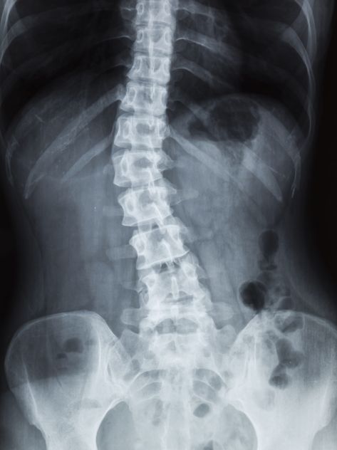 The Spiritual Cause of Scoliosis • Energetic Wisdom Spinal Injury, Sciatic Nerve Pain, Nerve Damage, Sciatic Nerve, Body Balance, Nerve Pain, Self Conscious, Book Of Life, Nerve