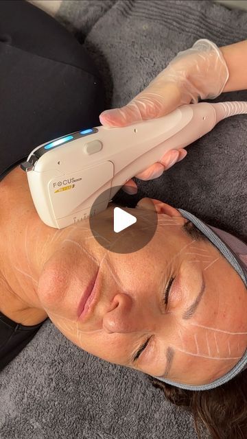 HIFU sculpts and enhances your facial contours by tightening all layers of skin.  Using next-generation facial ultrasound technology, we harness HIFU’s precise ultrasonic energy to achieve powerful regeneration.  First, we target the SMAS layer to lift and contour the lower face and jawline. Then, we focus on the dermis and epidermis to stimulate collagen production, resulting in plumper, tighter skin on the neck and face. Face Skin Tightening, Hifu Facial, Face Laser, Skin Tightening Face, Tighter Skin, Skin Clinic, Layers Of Skin, Collagen Production, Skin Tightening