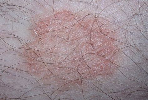 14 Rashes You Need to Know: Common Dermatologic Diagnoses Common Skin Rashes, Tinea Corporis, Ring Worm, Fungal Infection Skin, Antifungal Cream, Home Remedies For Skin, Skin Redness, Fungal Infection, Skin Disorders