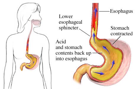 How To Manage Acid Reflux Symptoms Successfully - https://twitter.com/FleaAround/status/664723957895925760 Lemon Water In The Morning, Reflux Remedies, Asam Lambung, Stop Acid Reflux, Acid Reflux Recipes, Low Stomach Acid, Acid Reflux Diet, Reflux Symptoms, Reflux Disease