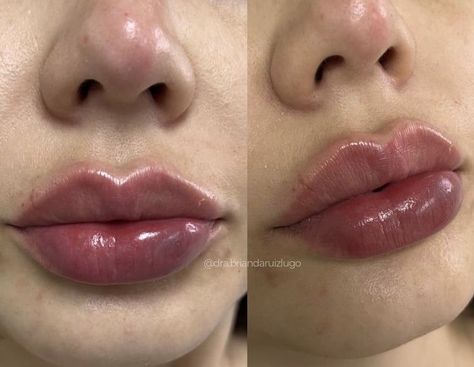 Butterfly Lip Filler, Perfect Lips Injections, M Shaped Lips, Desired Lips, Lip Filler Aesthetic, Pump Lips, Round Lips, Lip Filler Inspiration, 1ml Lip Filler