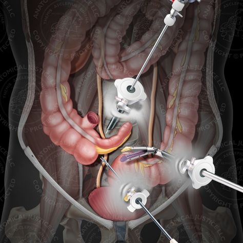 Improper transection of the right ureter during a laparoscopic appendectomy. The misidentification was due in part to the atypical position of the appendix and cecum.  #colon  #cecum #intestines #appendix #appendicitis #lapraroscopic #surgery #appendectomy #atypical  #thursday #thursdayvibes #throwbackthursday #doctor #medical #medmal #anatomicaljustice #medicalmask #medicalillustrations #medicaldevice  #giastapler #medart #legal #case #triallawyers #attorney #malpracticelawyer #visuals #illustr Appendix Surgery, Medical Masks, Medical Illustration, Medical Device, Doctor Medical, Biology, Surgery, Medical, Photography