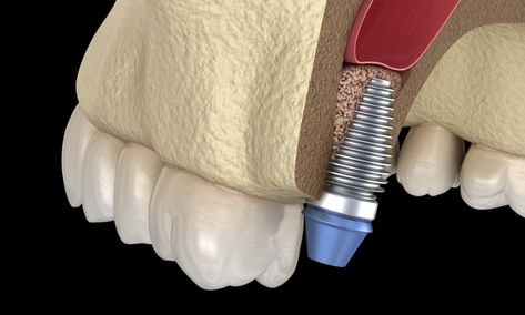 Your dentist may advise Sinus Lift Surgery if you want to get dental implants but don’t have sufficient jaw bone for the implants. This surgery is also called Sinus Augmentation or Sinus graft. It is usually performed by periodontists or oral surgeons as this is an advanced procedure. Oral Surgeon, Jaw Bone, Dental Implants, Surgery