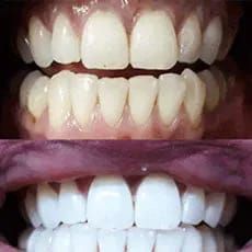 Whitening Mouthwash, Snow Teeth Whitening, Coconut Oil Teeth Whitening, Best Teeth Whitening Kit, Teeth Whitening Homemade, Teeth Whitening Toothpaste, Whitening Products, Teeth Whitening System, Pasta Dental