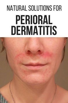 PERIORAL DERMATITIS: YOUR ULTIMATE GUIDE TO LONG-TERM HEALING Facial Rash Remedies, Redness Around Mouth, Exema Treatments For Face, Dry Bumpy Skin Face, Dry Red Patches On Face, Dry Patchy Skin On Face, Dry Red Skin On Face Remedies, Face Itching Remedies, Dry Red Skin On Face