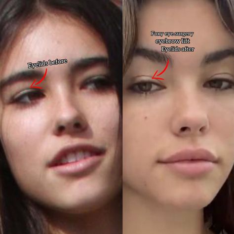 Madison Beer plastic surgery before and after Small Eyelids, Hooded Eye Lift Before And After, Eye Lift Before And After, Eyelid Lift Surgery Before After, Blethoplasty Before And After, Underbite Before And After, Eye Lift Surgery, Face Plastic Surgery, Botox Lips