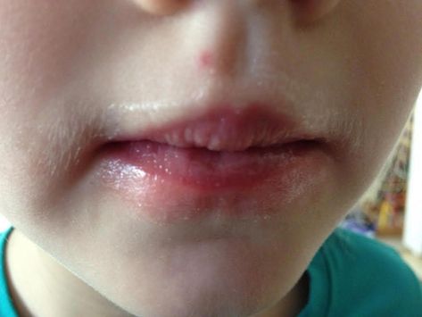 Chapped Skin Around Mouth, Redness Around Mouth, Chap Lips Remedy, Heal Chapped Lips Fast, Severe Chapped Lips, Chapped Lips Remedy Severe, Remedies For Chapped Lips, Lip Lickers, Dry Lips Remedy