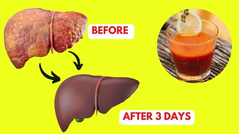 How to Liver Detox and Cleanse, Recipe, Home Remedies, Natural Remedies to avoid Fatty Liver Liver Detox Cleanse From Alcohol, Liver Cleanse Flush, Liver Cleanse Home Remedies, Cleanse Home, Detox For Kids, Liver Cleanse Juice, Cleanse Your Liver, Liver Detoxification, Liver Detox