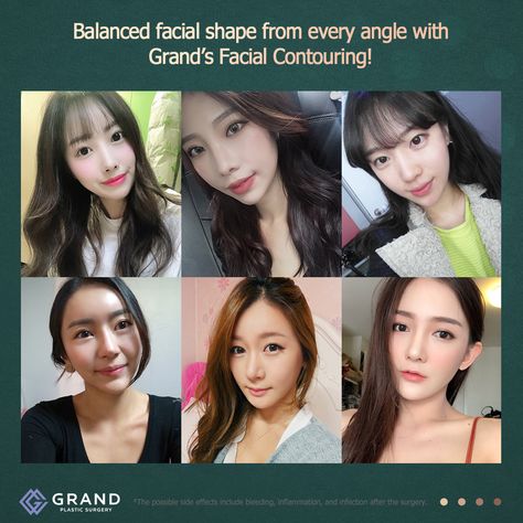 If you complain about your face appearance and dream about small and perfect shape of your face, so these surgeries perfectly suit for you~ Not only square jaw reduction, malar reduction and genioplasty, by individual consultation we will find the right method to make you look more gorgeous ! For online consultation🎀 Tel: (+82) 70-7119-1580 Mobile: (+82) 10-9132-6546 (Whatsapp, Line, Kakaotalk, Viber, iMessage) Email: grandps.en@gmail.com Facebook: Grand Plastic Surgery, Korea Website: eng.gran Square Jaw, Plastic Surgery Korea, Online Consultation, Shape Of You, Plastic Surgery, Surgery, Square