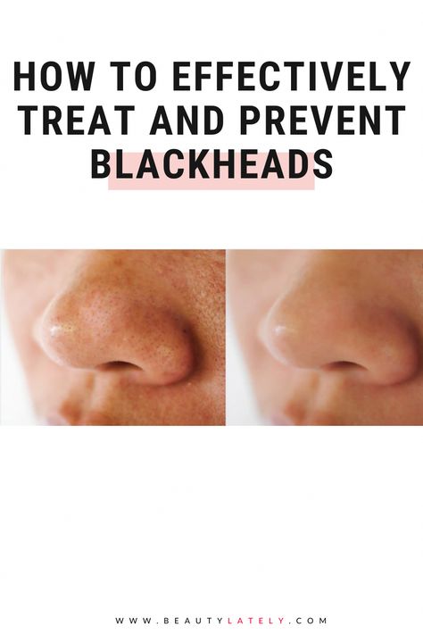 Blackheads can be annoying, unsightly, and difficult to manage. Learn how to get rid of pesky blackheads with the right products and ingredients. How To Avoid Blackheads, What To Use For Blackheads, How To Prevent Blackheads, Whiteheads Removal, Coldsore Remedies Quick, Acne Tips, Blackheads On Nose, Cold Medicine, Home Remedy For Cough