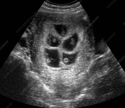 Triplets Ultrasound Pictures, Quadruplets Ultrasound, Quintuplets Pregnancy, Triple Ultrasound, 5 Weeks Pregnant Ultrasound Pictures, Pregnancy Anatomy, 5 Months Pregnant Ultrasound, 2 Weeks Pregnant Ultrasound, Pregnancy Tattoo