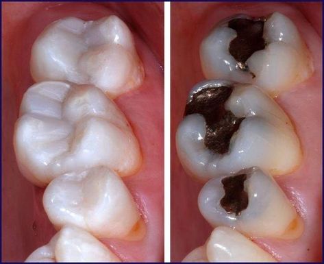 Cosmetic fillings used to replace unsightly amalgam fillings. Find out your options by calling us on 01283 707385 or emailing hello@thepracticewillington.co.uk  #whitefillings #compositefillings #smile Composite Fillings Tooth, Amalgam Fillings, Composite Fillings, Regrow Tooth Enamel Heal Cavities, Arte Alien, Composition, Silver, Quick Saves