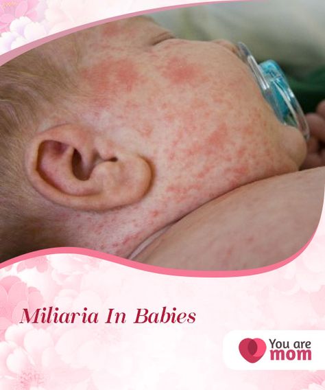 Miliaria In Babies   Miliaria in babies, also known as sudamina, is more common than you can #imagine. It is a skin rash that occurs in babies due to their #delicate #skin.  #Health Heat Rash Remedy For Babies, Heat Rash On Face, Red Bumps On Face, Face Rash Remedies, Skin Rash On Face, Baby Rash On Face, Baby Heat Rash, Heat Rash Remedy, Home Remedies For Rashes