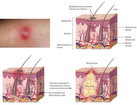 Infected Hair Follicle, Subcutaneous Tissue, White Blood Cells, Blood Cells, Hair Follicle, The Skin, A Small, Skin, Hair