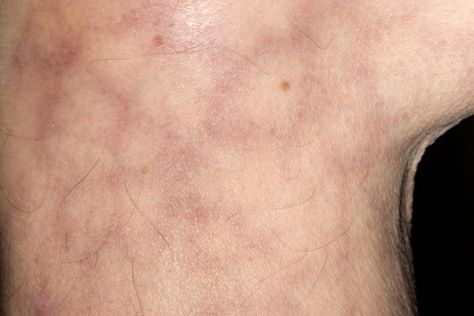 Mottled Skin, Livedo Reticularis, Itchy Legs, Nurse Practioner, Lies Of P, Autoimmune Disorders, Homemade Facial Mask, Pharmacology Nursing, Health Guru