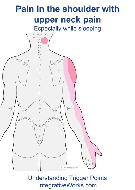 Trigger Points - Neck Pain with Sore Shoulder | Integrative Works Sore Shoulder, Back Pain Remedies, Trigger Points, Shoulder Pain, Neck Pain, Back Pain, Right Side