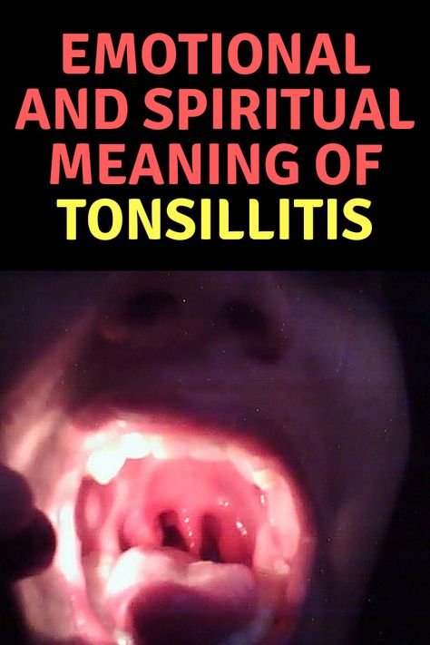 Tonsilitis Symptoms, Herbs For Tonsilitis, Swollen Throat Remedies, Tonsil Stone Remedies, Swollen Tonsils Remedy, Tonsils Home Remedies, Tonsillitis Symptoms, Remedies For Swollen Tonsils, Lump In Throat