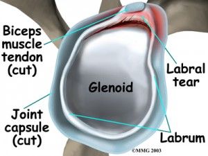 Labral tears: Very much over-diagnosed and over-treated.  When are they a problem and when can they be ignored.  Very  few people require surgery for a labral repair. Labral Tear Shoulder, Trapezius Muscle Pain, Shoulder Anatomy, Shoulder Dislocation, Shoulder Rehab, Rotator Cuff Tear, Rotator Cuff Injury, Medical Transcription, Bicep Muscle