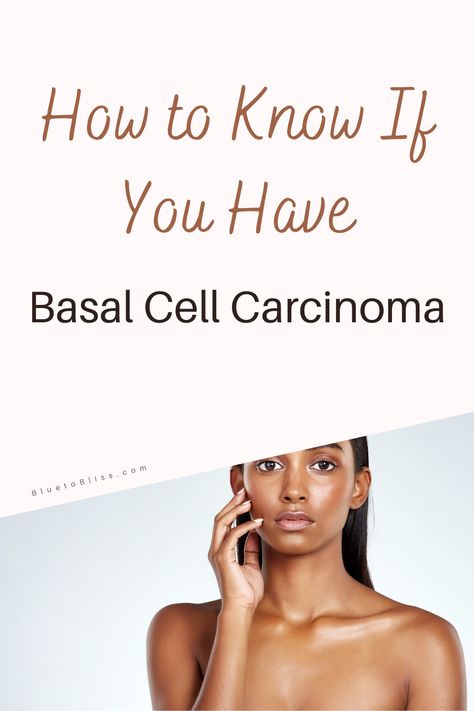 Wondering what that strange spot is on your skin? Learn how to know if you have basal cell carcinoma. #skincancerawareness #skincanceronface #skincancersigns #skincancerdiagnosis #skincancerpictures #skincancertreatment #treatmentforskincancer #basalcellcarcinoma #basalcellcarcinomapictures #basalcellcarcinomatreatment #basalcellcarcinomawarningsigns #basalcellcarcinomaremoval Basal Cell On Face, Basel Cell Carcinoma Pictures, Basil Cell Carcinoma, Dermatologist Recommended Skincare, Basal Cell, Squamous Cell, Doctor's Office, Cell Growth, Workout Chart