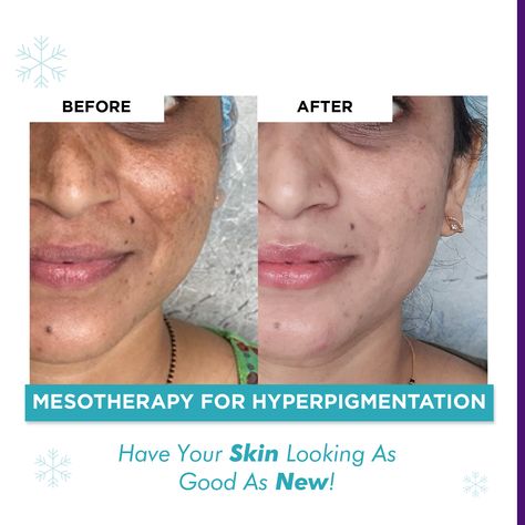 Mesotherapy Before And After, Mesotherapy Face, White Eyeliner Looks, Green Eyeshadow Look, Good Morning Coffee Images, White Eyeliner, Simple Makeup Looks, Coffee Images, Hooded Eye Makeup