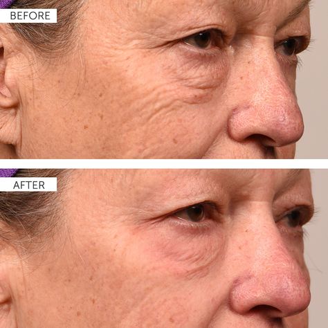 Before and after eye treatment for puffy eyes Eye Killer, Puffy Eye, Chest Wrinkles, Eye Wrinkles, Neck Wrinkles, Crepey Skin, Under Eye Wrinkles, Medical Grade Silicone, Skin Tissue