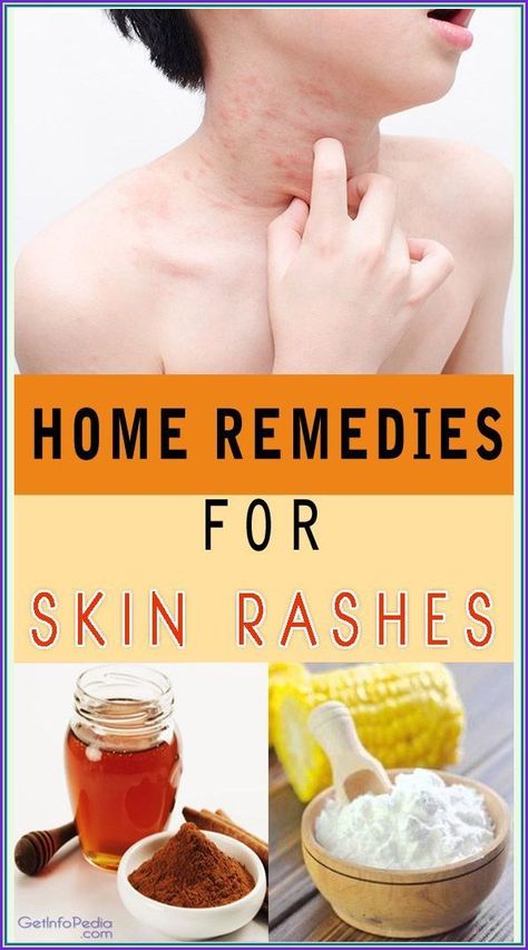 Natural Home Remedies For Skin Rashes Home Remedies For Rashes, Rashes Remedies, Remedies For Skin, Prediabetic Diet, Home Remedies For Skin, Skin Rashes, Health Planner, Skin Irritation, Natural Home Remedies