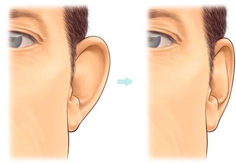 Ear correction surgery, including ear pinningEar surgery is considered to be cosmetic surgery as its aim to change the shape and size of people’s ears. However, there are still can be some risks and, of course, this type of sur… Ear Pinning Surgery, Ear Surgery, Surgery Humor, Types Of Surgery, Ear Pins, Plastic Surgeon, Cosmetic Surgery, Plastic Surgery, Keep It Cleaner