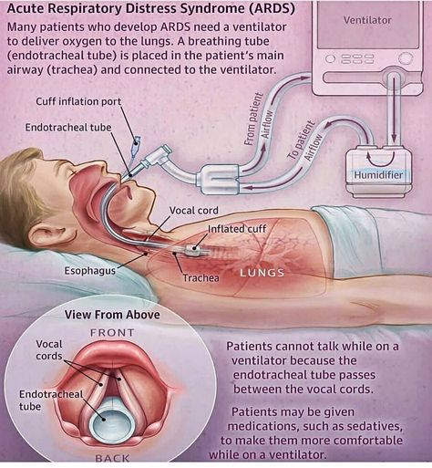 Acute Respiratory Distress, Respiratory Therapy Student, Respiratory Distress, Nurse Study Notes, Nursing Student Tips, Surgical Nursing, Medical Surgical Nursing, Mechanical Ventilation, Medical Student Study