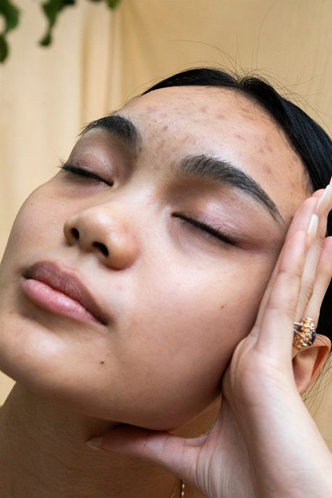 The “Skin Neutrality” Movement Is Growing — But I Can’t Get On Board #refinery29 https://www.refinery29.com/en-us/2019/12/8992367/skin-neutrality-positivity-acne Imperfect Skin Aesthetic, Real Skin Aesthetic, Acne Positivity Art, Acne Photoshoot, Strawberry Freckles, Women With Acne, Acne Aesthetic, Imperfect Skin, Beautiful Acne