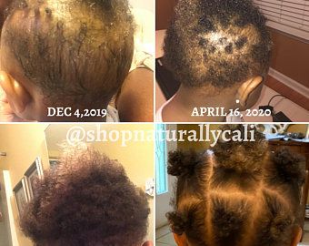 Dominican Hair Salon, Rosemary Oil Hair Growth, Alopecia Hair Growth, Hair Growth Cream, Regrow Thinning Hair, Black Hair Natural, Dominican Hair, Herbal Hair Growth, Traction Alopecia