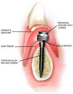 Mini Dental Implants Cost & Prices Paid Dental Dentures, Implants Dental, Pinterest Tutorials, Medical Transcription, Dental Implants Cost, Missing Teeth, Teeth Implants, Tongue Cleaner, Dental Cleaning