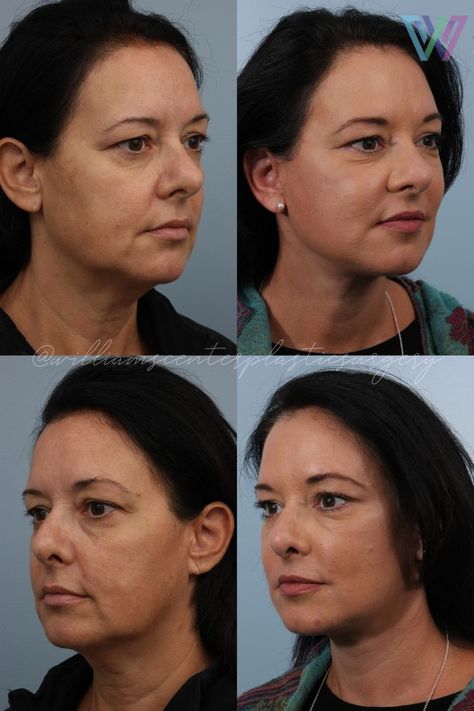 Does a facelift procedure leave scars? Dr. Williams has a blog written about the incision lines used during a deep plane facelift surgery. Plastic Surgery, Cosmetic Surgery, New York Plastic Surgery, Facelift Before and After, Plastic Surgery Photos Lower Face Lift Before And After, Lower Face Lift, Deep Plane Facelift, Face Plastic Surgery, Scar Healing, Facelift Surgery, Facelift Before And After, Facelift Procedure, Plastic Surgery Photos