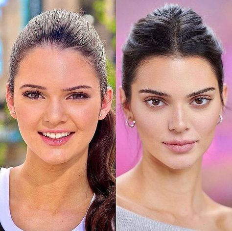 Kardashians Before And After, Kendall Jenner Plastic Surgery, Kendall Jenner Eyes, Perfect Face Shape, Face Plastic Surgery, Rhinoplasty Nose Jobs, Rhinoplasty Before And After, Rhinoplasty Surgery, Facial Fillers