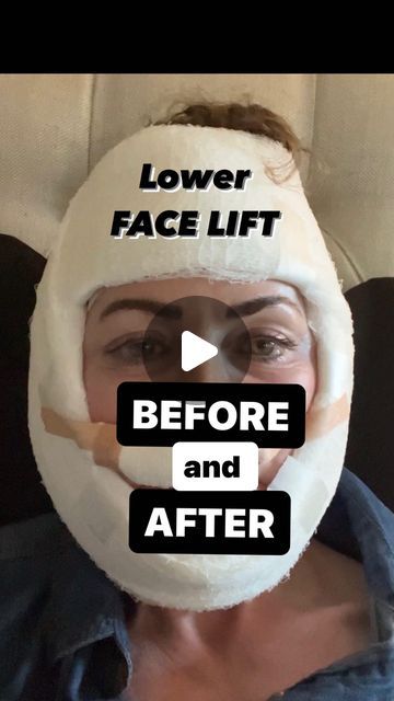 9,879 likes, 848 comments - fit__momof7 on March 27, 2023: "59 yr old Mom of 7. Lower face lift. Jowls, Lip lift, neck, buccal fat pads ( little pockets of f..." Endoscopic Brow Lift Before And After, Lower Facelift Before And After, Chin Lift Before And After, Face Lift Before And After, Neck Lift Before And After, Deep Plane Facelift Before And After, Lower Face Lift Before And After, Mini Face Lift Before And After, Lip Lift Before And After