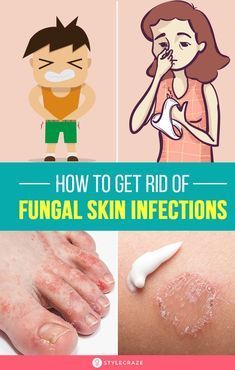 Fungal Infection Remedies, Fungal Infection Skin, Skin Care Routine For 20s, Infection Prevention, Bacterial Infection, Fungal Infection, Nail Fungus, Natural Treatments, Skin Treatments