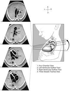 Ultrasound Humor, Cardiac Assessment, Diagnostic Medical Sonography Student, Ultrasound School, Cardiac Anatomy, Obstetric Ultrasound, Cardiac Sonography, Intervention Strategies, Medical Management