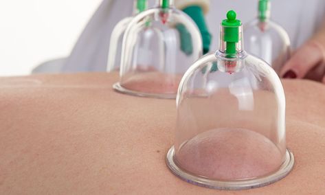 Massage cupping techniques have grown in popularity, representing a great victory for the Eastern paradigm of health and wellness Cupping Techniques, Massage Therapy Career, Sport Massage, Benefits Of Cupping, Dream Nature, Hijama Cupping, Massage Cupping, Cupping Massage, Facial Cupping