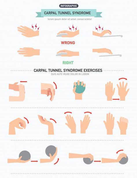 Carpal tunnel syndrome infographic | Premium Vector #Freepik #vector #infographic #hand #computer #medical Carpal Tunnel Relief Exercises, Hand Therapy Exercises, Carpal Tunnel Exercises, Carpal Tunnel Relief, Wrist Exercises, Occupational Therapy Activities, Physical Therapy Exercises, Hand Exercises, Vector Infographic