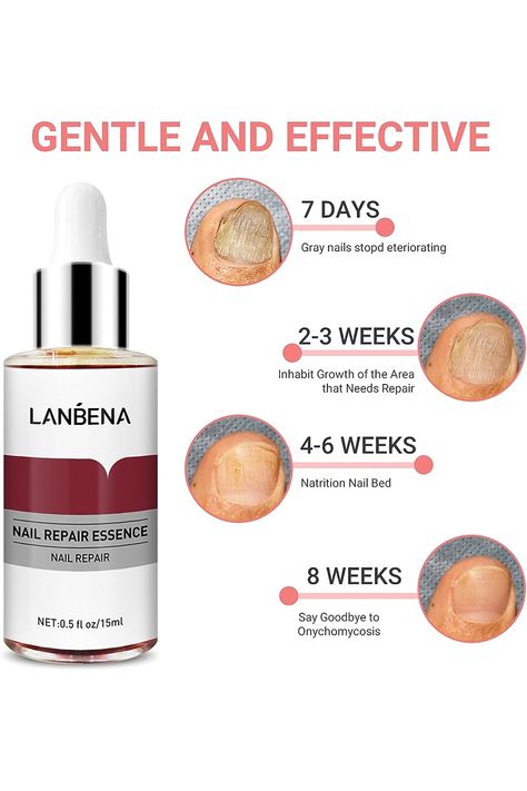 LANBENA Nail Repair Essence, Nails Repair Essence Nail Repair for Damaged Nails Protect Nail from Damage Fingernail and Toenail Repair for Curing Nail from Infection Discolored and Damaged Nails(12ml) Nail Damage Remedies, Nail Break Repair, Broken Nail Repair, Nail Bed Damage Repair, Split Nail Repair, Fixing Broken Nail, Nails Repair, Essence Nails, Apply Nail Polish