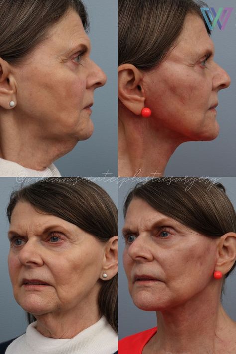 A facelift, also known as a rhytidectomy, is a surgical procedure done to provide the face with a healthy, more youthful appearance by treating the tell-tale signs of aging. Facelifts are designed to treat the sagging tissues of the jowls, cheeks, and neck by removing excess fat, tightening muscles, and re-draping the skin. Facelift before and after, mini facelift, cheek fillers before/after, plastic surgery, cosmetic surgery Retirement Wishes Quotes, Happy Retirement Wishes, Facelift Before And After, Sagging Cheeks, Plastic Surgery Photos, Cheek Fillers, Natural Therapy, Double Chin, Upstate New York