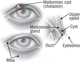 I have small white bumps on my eyelids, which are driving me crazy. They don't hurt, but they look awful. I've been told they're Meibomian cysts and that the only solution is surgery. What is your take on this? White Bump On Eyelid, Driving Me Crazy, Swollen Eyes, Irritated Eye, Clear Liquids, Clear Eyes, Take Care Of Your Body, Bacterial Infection, Baby Shampoo